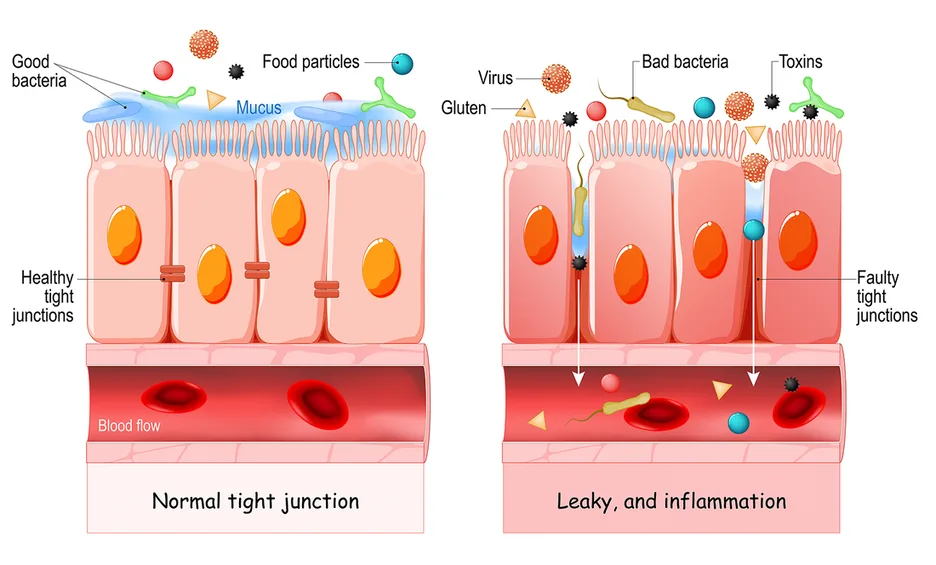 Diagram comparing a normal tight junction in the gut lining to a leaky, inflamed junction